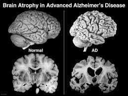 Penyakit Alzheimer Bukanlah Penyakit Dimensia